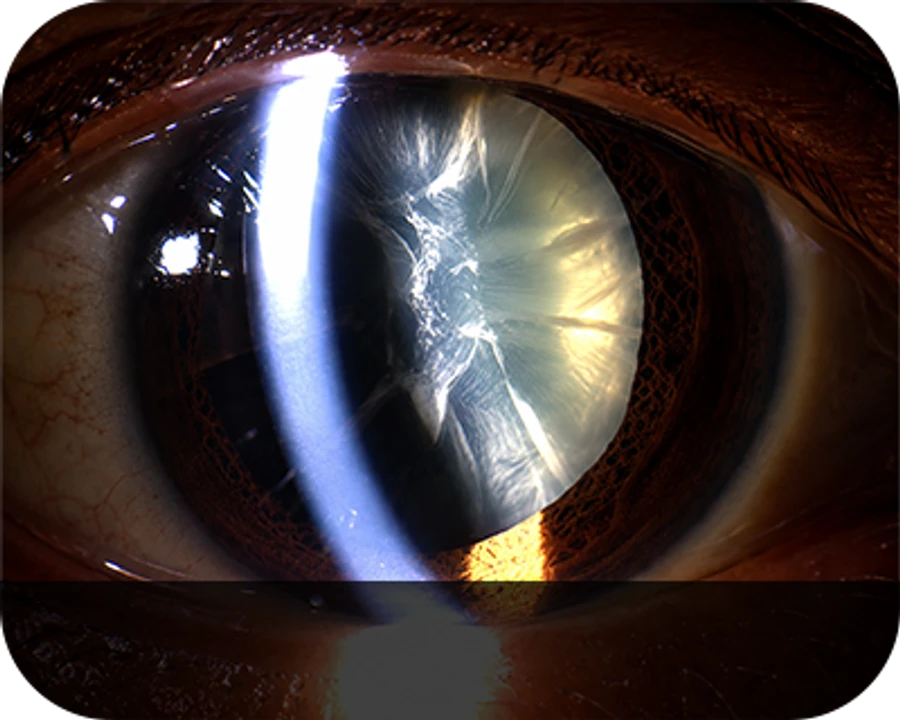 Cataractous Lens