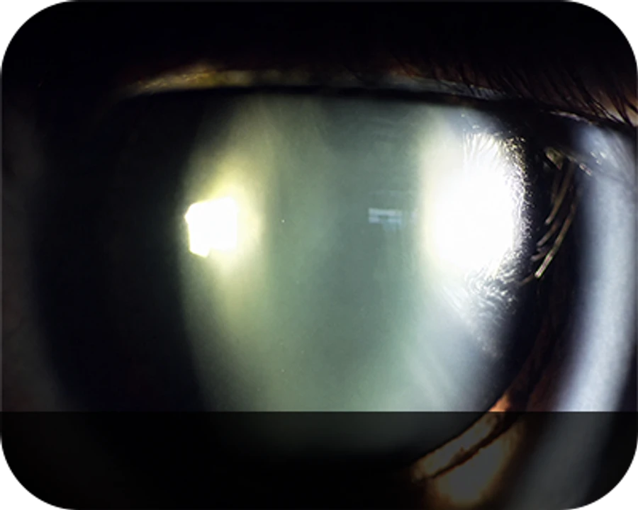 Normal Crystalline Lens