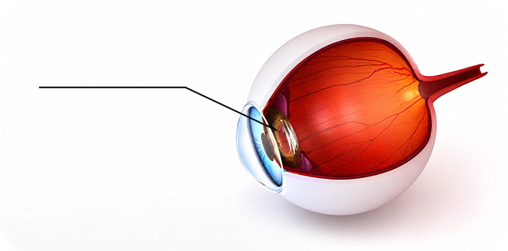 Cataract eye anatomy illustration — lens opacification causing decreased visual acuity