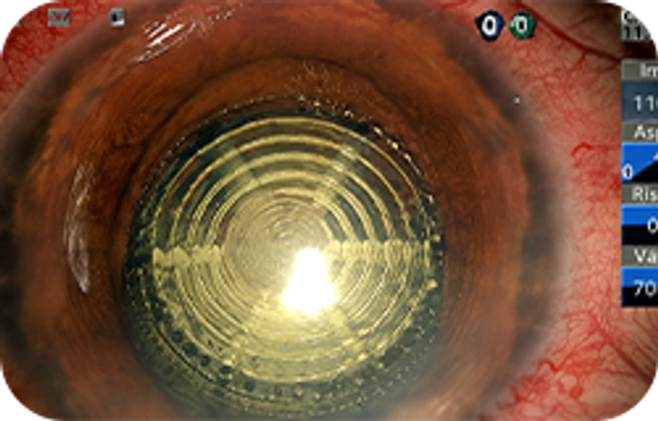 Laser-precise corneal incision without error