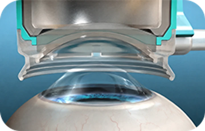 Limbal relaxing incision for astigmatism correction