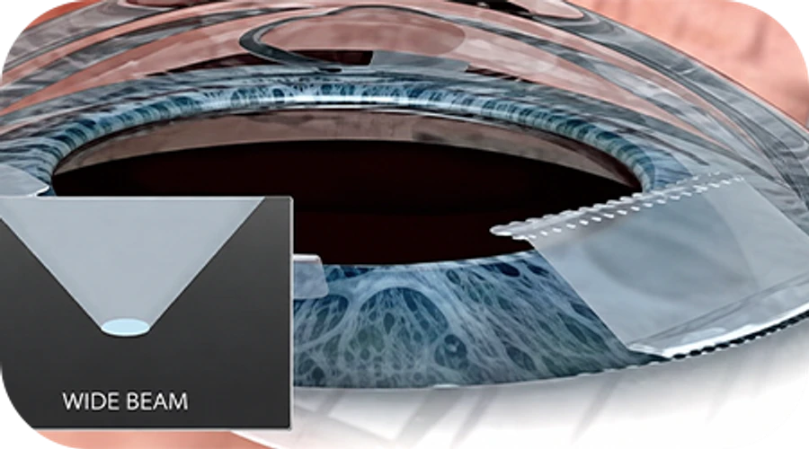 LenSx cataract surgery step-by-step diagram — [Laser Corneal Incision Creation]