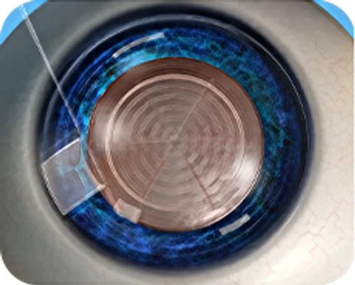 Femtosecond laser-assisted cataract surgery — step-by-step diagram — Step 1