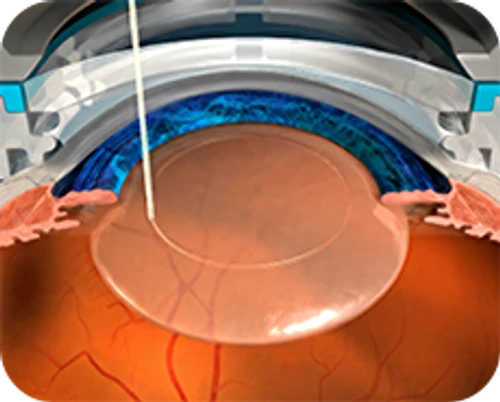 Femtosecond laser-assisted cataract surgery — step-by-step diagram — Step 2