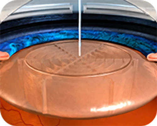 Femtosecond laser-assisted cataract surgery — step-by-step diagram — Step 3