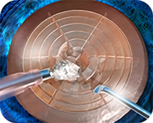 Femtosecond laser-assisted cataract surgery — step-by-step diagram — Step 4