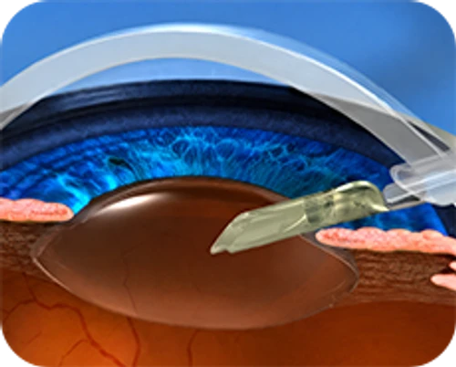 Femtosecond laser-assisted cataract surgery — step-by-step diagram — Step 5