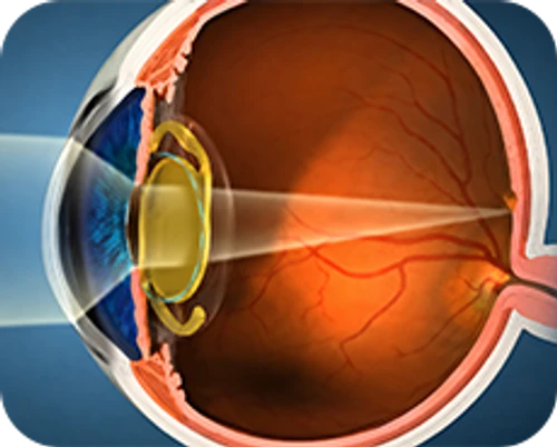 Femtosecond laser-assisted cataract surgery — step-by-step diagram — Step 6