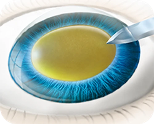 Ultrasound phacoemulsification cataract surgery — step-by-step diagram — Step 1