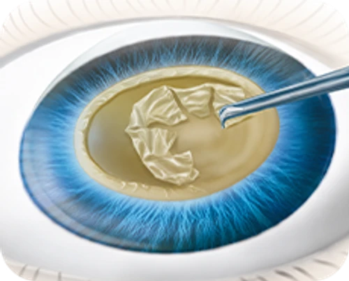 Ultrasound phacoemulsification cataract surgery — step-by-step diagram — Step 2