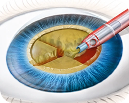 Ultrasound phacoemulsification cataract surgery — step-by-step diagram — Step 3