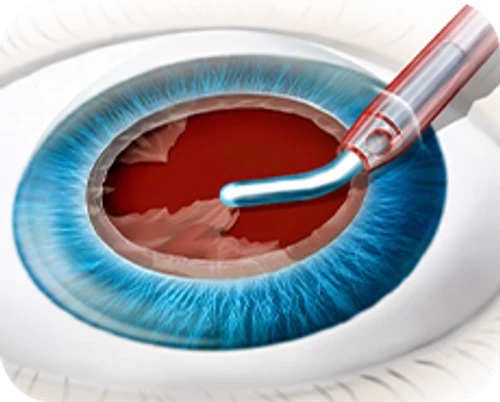 Ultrasound phacoemulsification cataract surgery — step-by-step diagram — Step 4