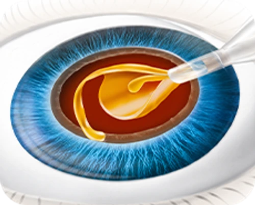 Ultrasound phacoemulsification cataract surgery — step-by-step diagram — Step 5