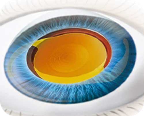 Ultrasound phacoemulsification cataract surgery — step-by-step diagram — Step 6