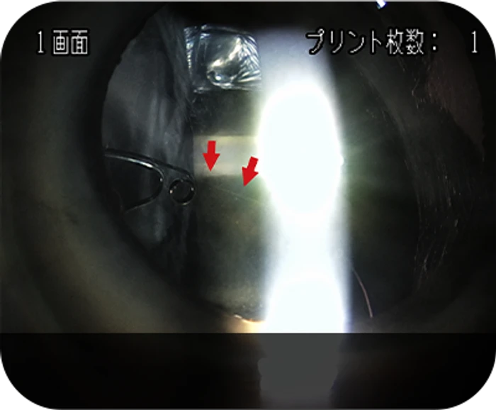IOL dislocation case 1