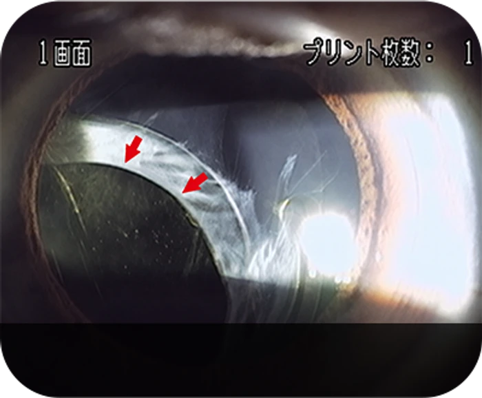 IOL dislocation case 2