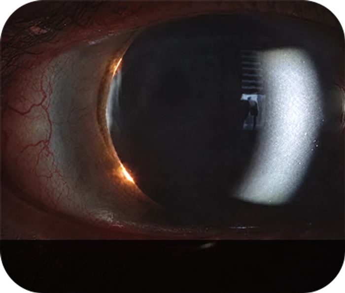 After YAG laser posterior capsulotomy — slit lamp photograph