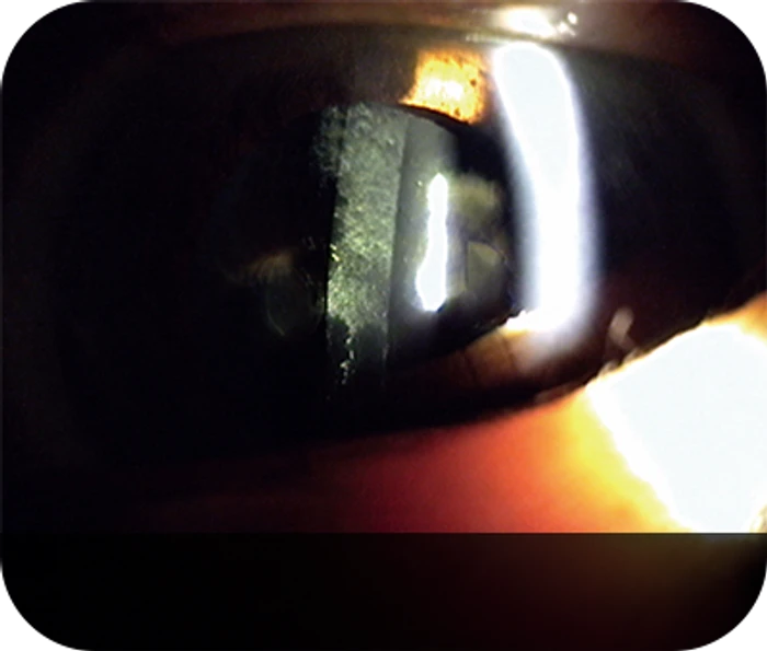 Posterior capsular opacification before treatment — slit lamp photograph