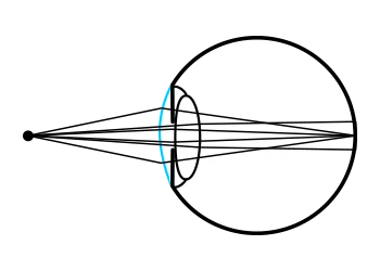 Refractive pathway of an astigmatic eye