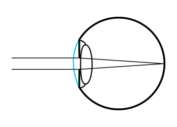 Refractive pathway of a normal eye
