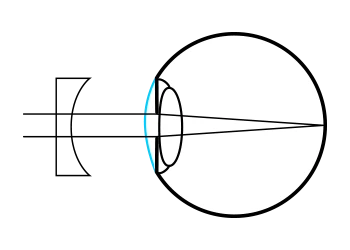 Refractive pathway after myopia correction