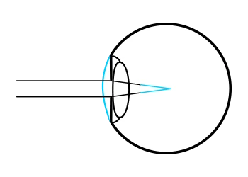 Refractive pathway of a myopic eye