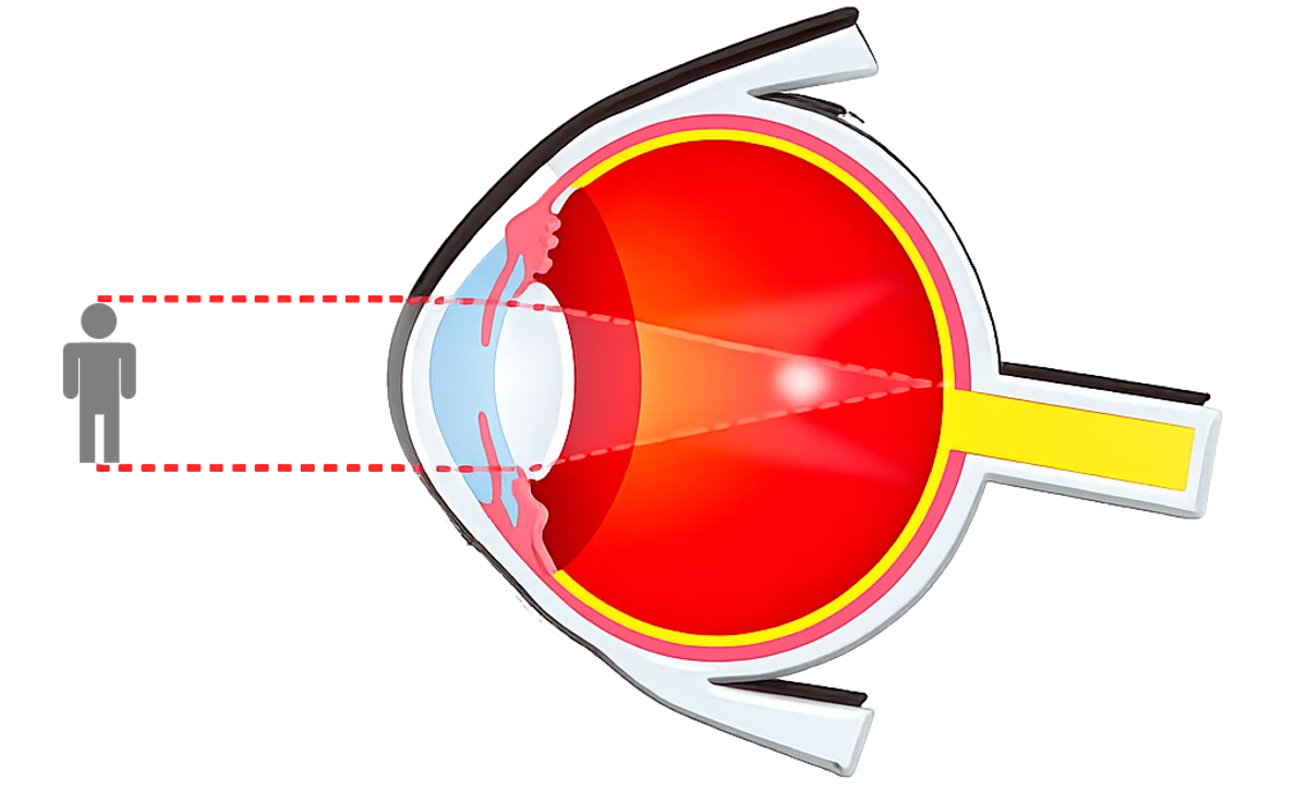 Illustration comparing a normal lens to a presbyopic lens