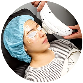 IPL laser periocular vascular treatment
