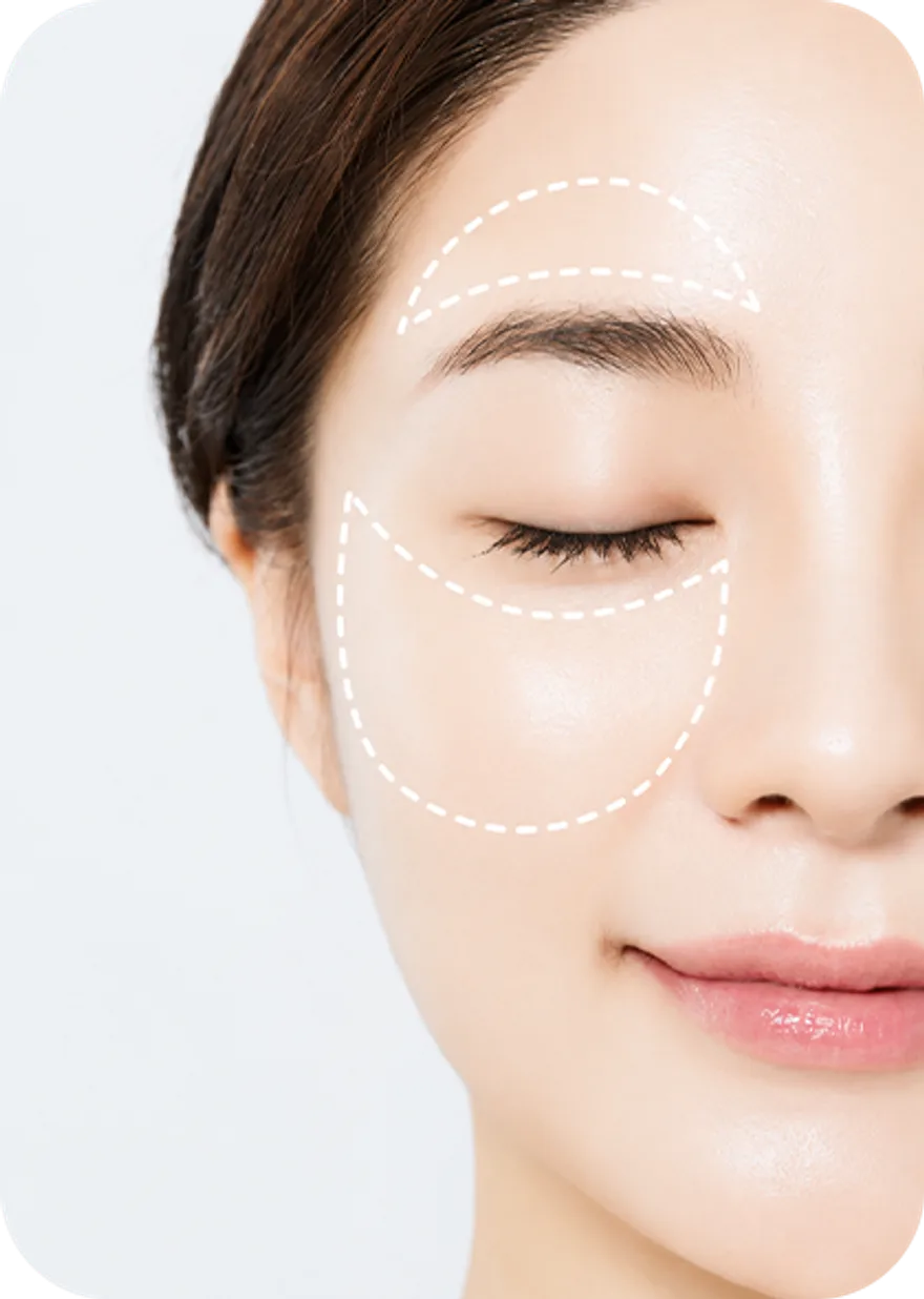 Treating the root cause of dry eye with IPL Therapy