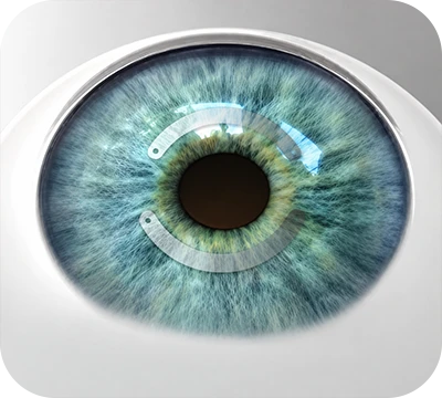 Intacs (Intracorneal Ring Segments)
