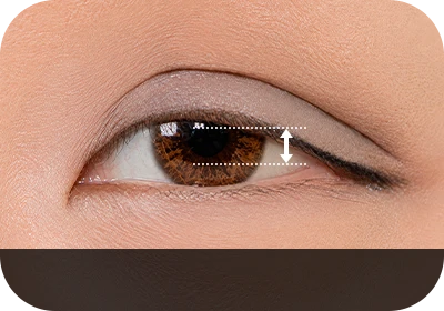 Ptotic Eyelid