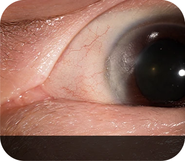 Conjunctival degeneration