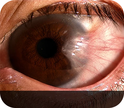 Conjunctival degeneration