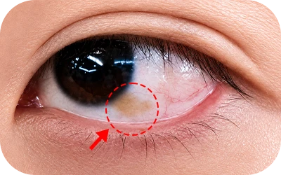 What is conjunctival nevus 1
