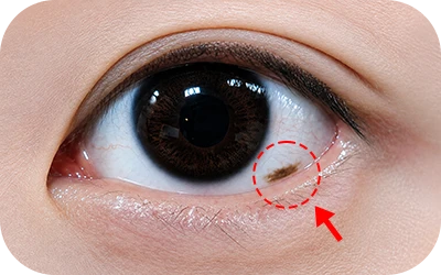 What is conjunctival nevus 2