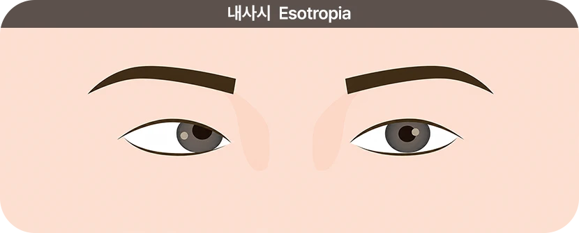 내사시
