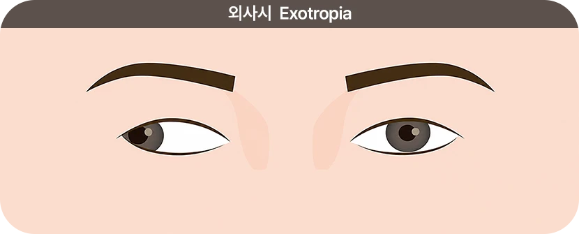 외사시