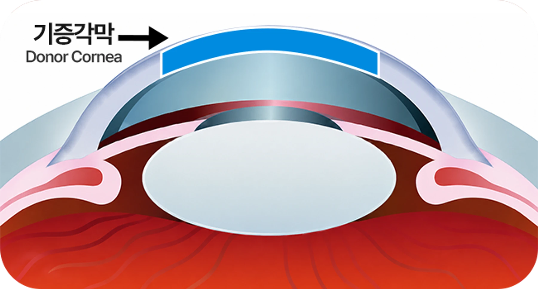 Illustration of penetrating (full-thickness) keratoplasty