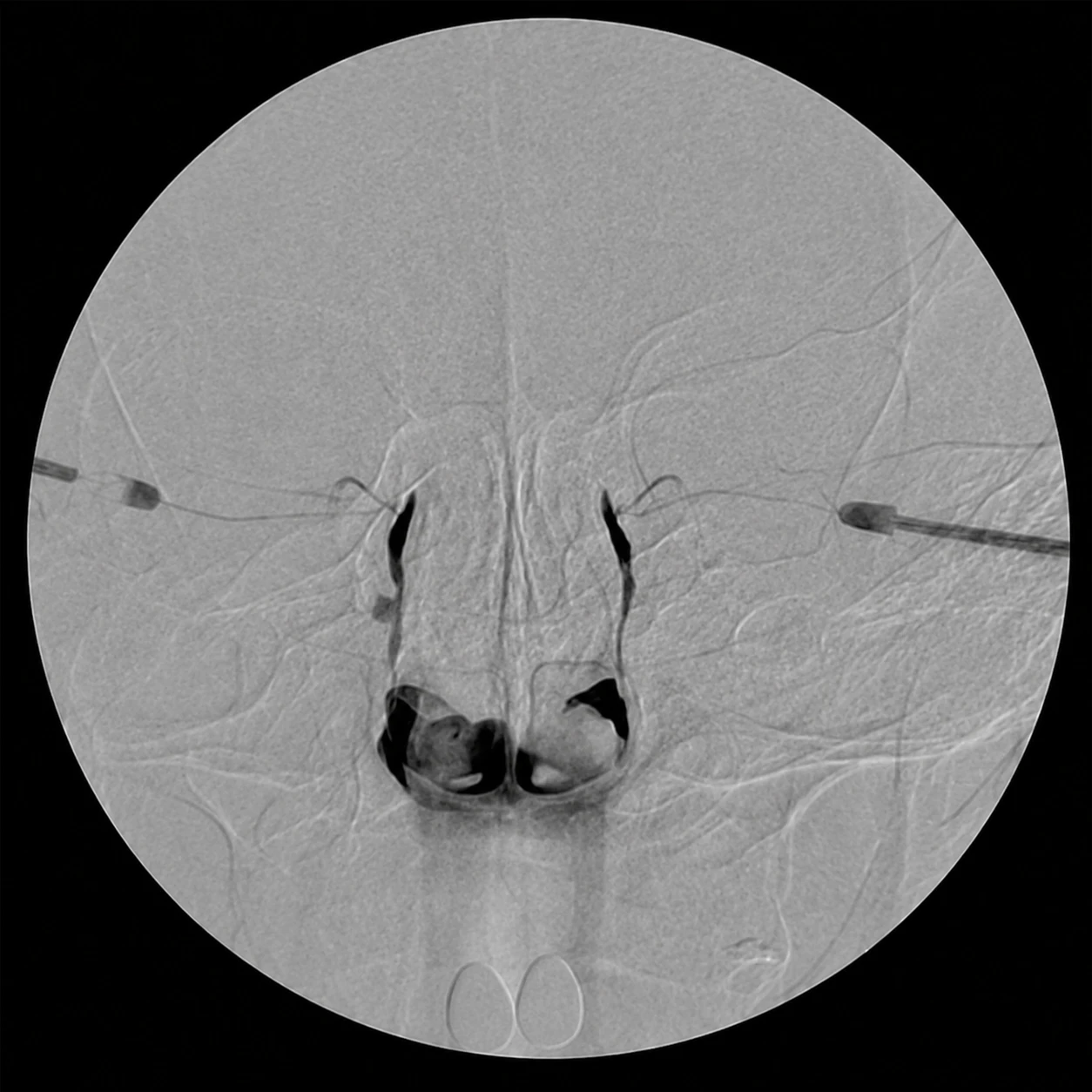 Dacryocystography (DCG) Workup — X-ray 1