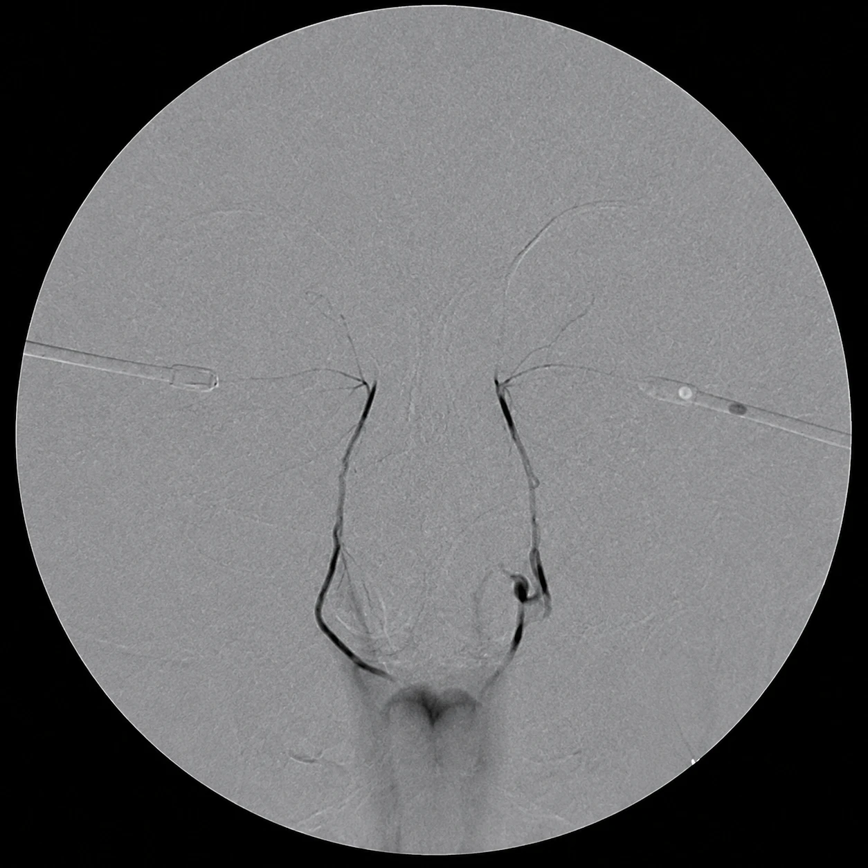 Dacryocystography (DCG) Workup — X-ray 2