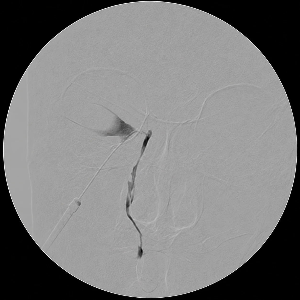 Dacryocystography (DCG) Workup — X-ray 3