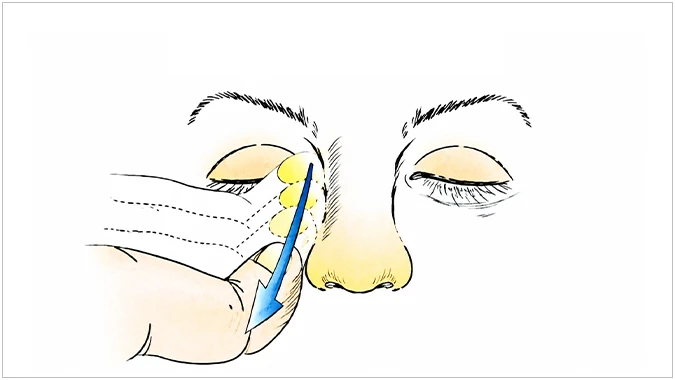 Lacrimal sac massage with antibiotic drops