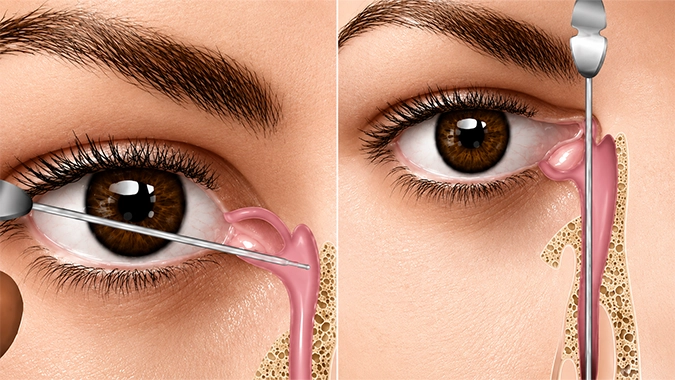 Lacrimal probing