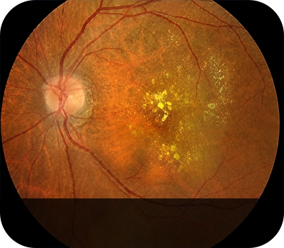 비삼출성 황반변성 증상안 Eye with Dry Age-Related Macular Degeneration