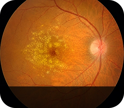 삼출성 황반변성 증상안 Eye with Wet Age-Related Macular Degeneration