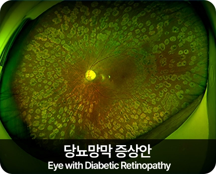 당뇨망막 증상안 Eye with Diabetic Retinopathy