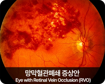 망막혈관폐쇄 증상안 Eye with Retinal Vein Occlusion (RVO)