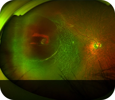 망막박리 증상안 Eye with Retinal Detachment