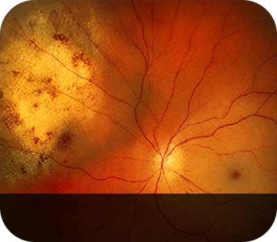 삼출망막박리 증상안 Eye with Exudative Retinal Detachment