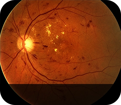 비증식당뇨망막병 증상안 Eye with Non-Proliferative Diabetic Retinopathy